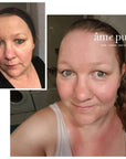 amepure, dermaroller, âme pure resultater, fjerne pigmentflekker, før og etter, microneedling, skin roller, dermapen, mesoterapi, âmepure