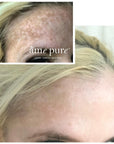 amepure, dermaroller, âme pure resultater, fjerne pigmentflekker, før og etter, microneedling, skin roller, dermapen, mesoterapi, âmepure