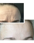 amepure, dermaroller, âme pure resultater, fjerne pigmentflekker, før og etter, microneedling, skin roller, dermapen, mesoterapi, âmepure. fjerne rynker, rynker dermaroller