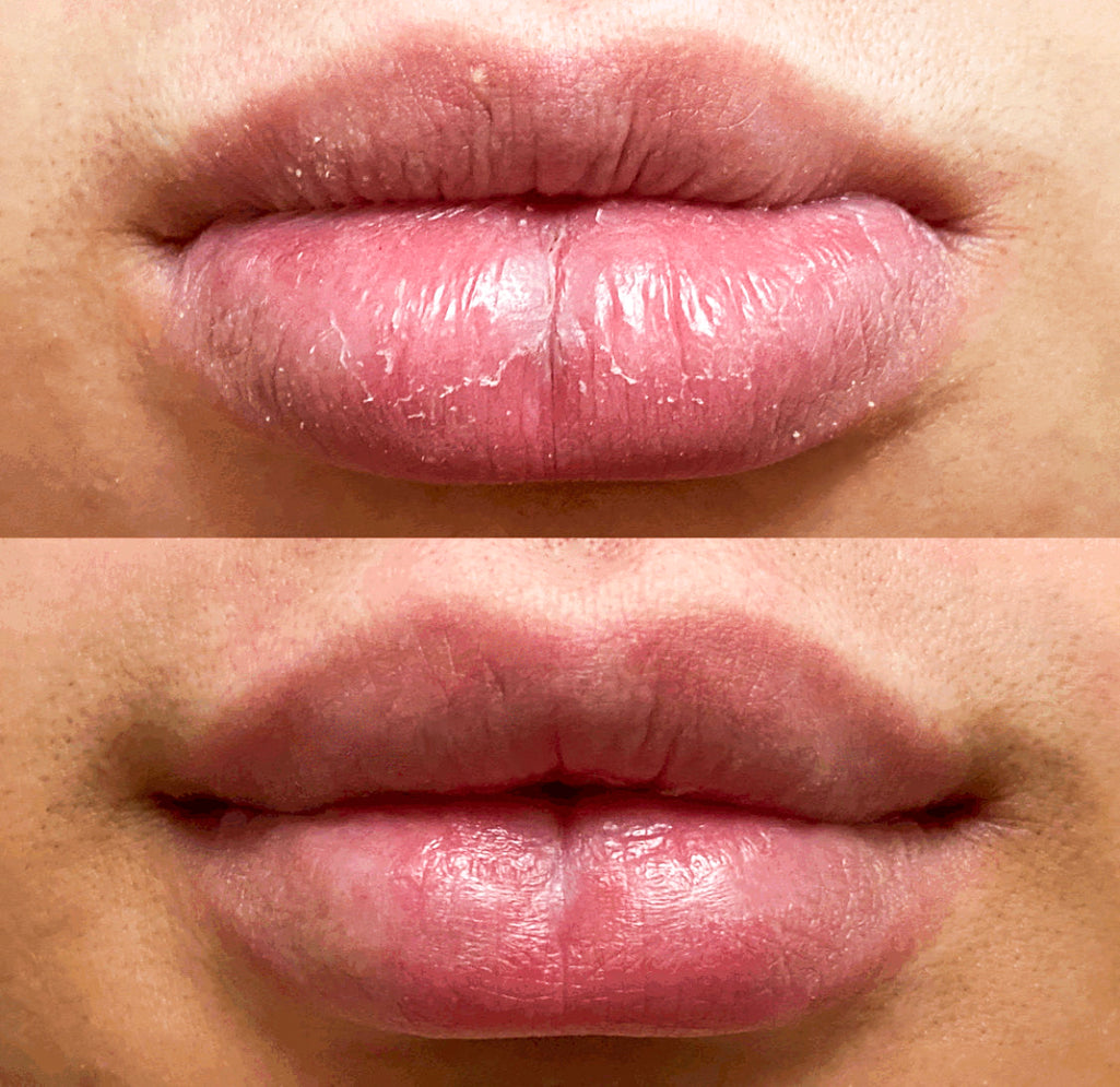 før og etter tørre lepper, leppepleie, leppepomade, lip balm, leppe balm, leppemaske
