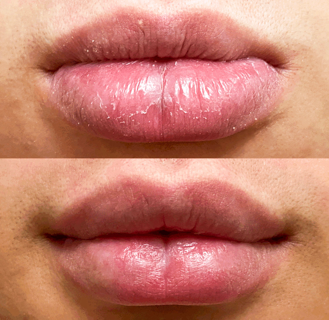 før og etter tørre lepper, leppepleie, leppepomade, lip balm, leppe balm, leppemaske